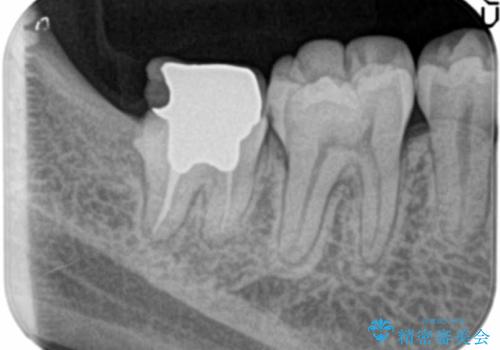 歯ぐきの深い位置まで虫歯が　歯周外科→被せもの による奥歯の治療の治療前