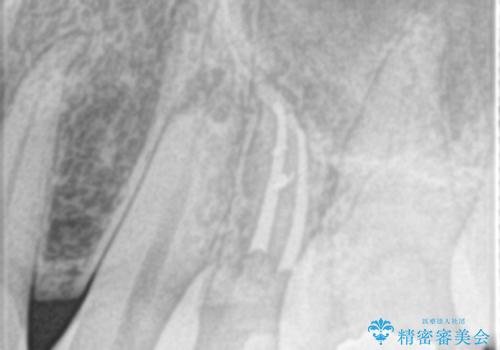 歯の神経の壊死による炎症への対応:湾曲根管を持つ左上4番の治療後