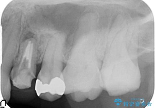 左上4番目の歯で咬むと痛むと来院された方のオールセラミッククラウンの治療前