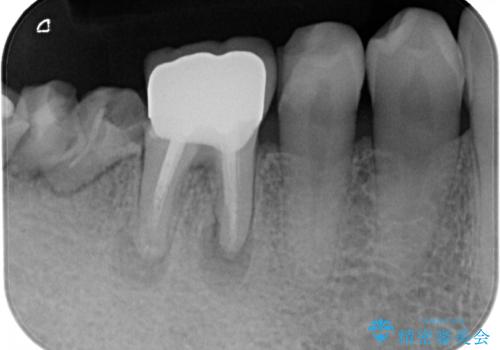 下の奥歯のインプラントと根管治療での咬合回復の治療前