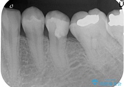 深い虫歯での神経を残す治療:左下5番への生活歯髄療法の治療後