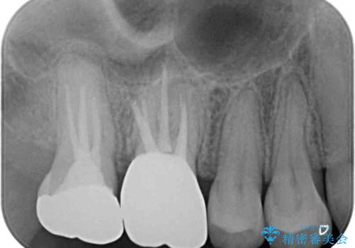 割れた奥歯 インプラントによる咬合回復の治療後