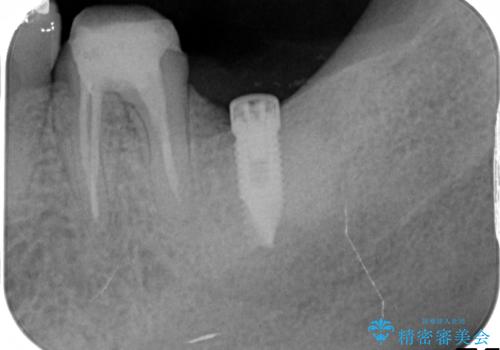 インプラント周囲の歯肉移植～最終的なセラミックを入れるまでの治療前