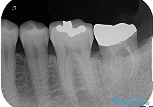 他院で仮歯が壊れまくる　高さの無い歯のゴールドクラウンの治療後