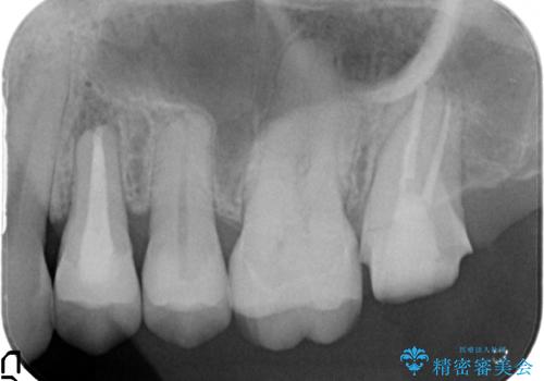 左上4番目の歯で咬むと痛むと来院された方のオールセラミッククラウンの治療後