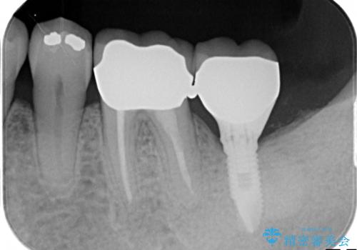 インプラント周囲の歯肉移植～最終的なセラミックを入れるまでの治療後