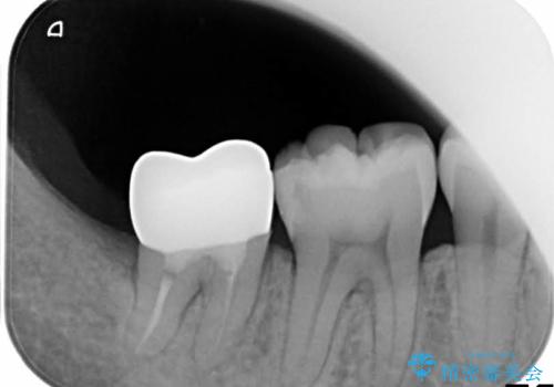 歯ぐきの深い位置まで虫歯が　歯周外科→被せもの による奥歯の治療の治療後