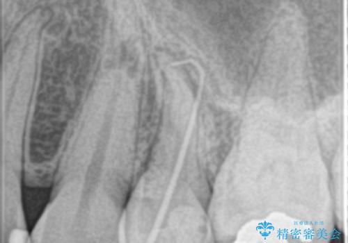 歯の神経の壊死による炎症への対応:湾曲根管を持つ左上4番の治療前