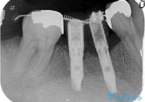 小矯正を伴う臼歯部インプラント補綴の治療中