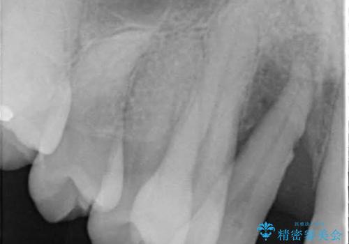 重度歯周炎の歯を抜歯してワイヤー矯正を　変則的なかみ合わせで仕上げるの治療前