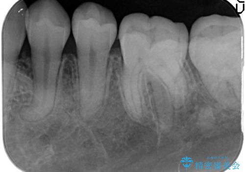 30代女性　抜かない矯正　出っ歯　低位歯を並べましたの治療後