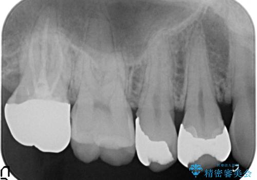 奥歯の精密虫歯治療の治療前
