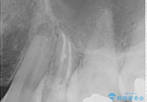 歯の神経の壊死による炎症への対応:湾曲根管を持つ左上4番の治療後