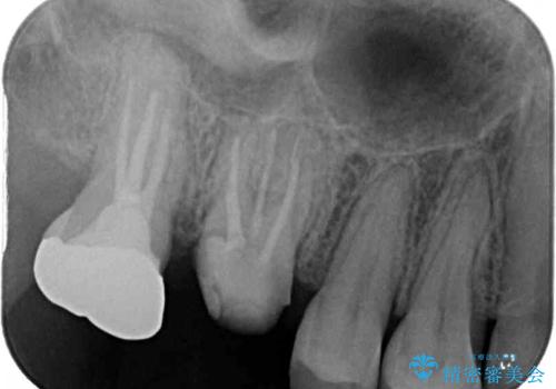 割れた奥歯 インプラントによる咬合回復の治療前