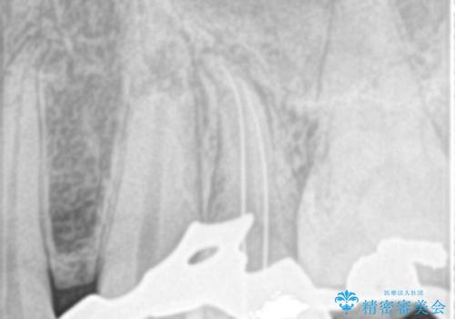歯の神経の壊死による炎症への対応:湾曲根管を持つ左上4番の治療中