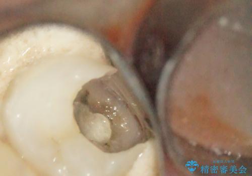 深い虫歯での神経を残す治療:左下5番への生活歯髄療法の治療中