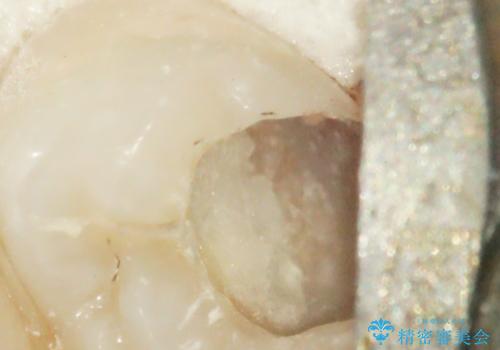 深い虫歯での神経を残す治療:左下5番への生活歯髄療法の治療中