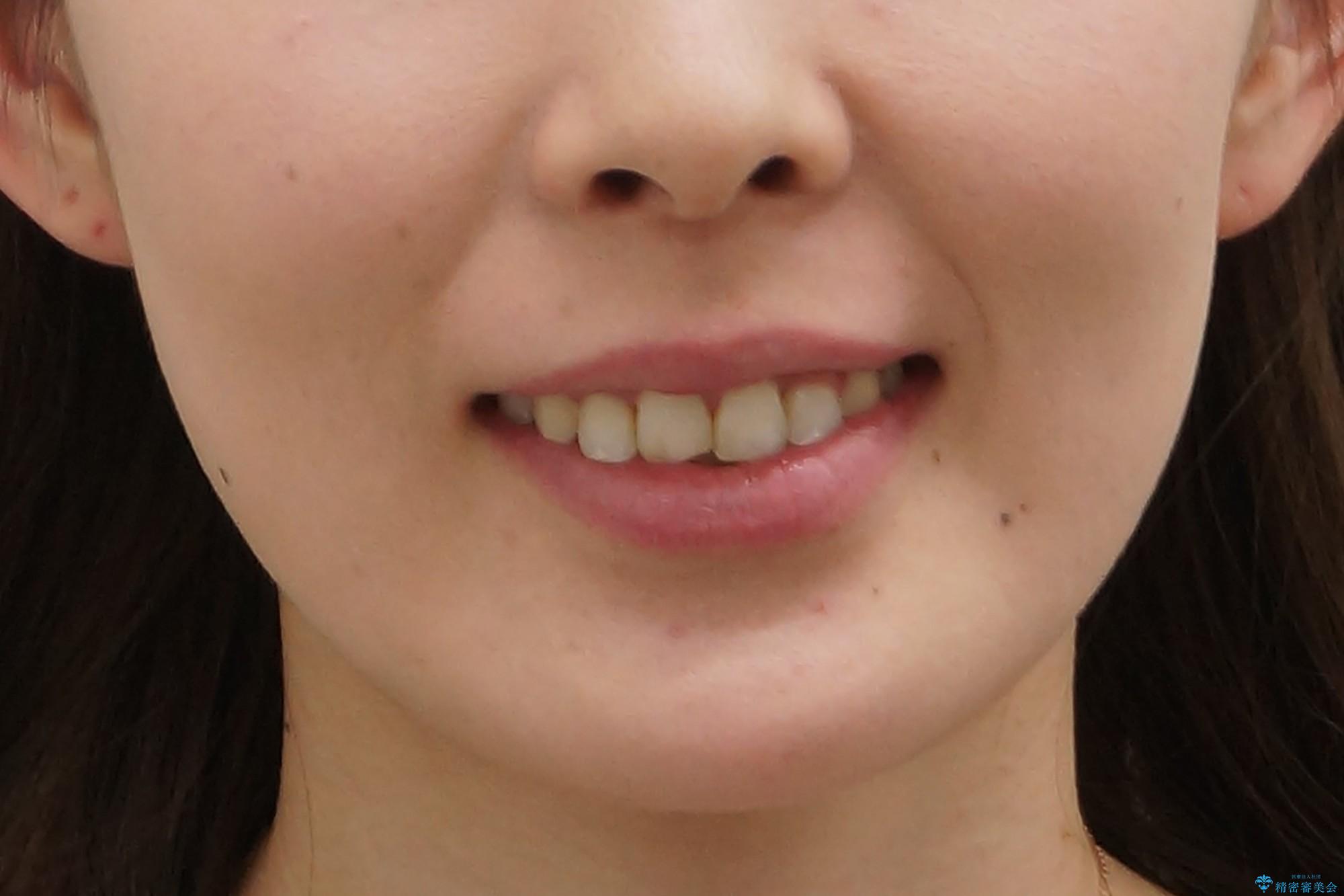 30代女性　抜かない矯正　出っ歯　低位歯を並べましたの治療後（顔貌）