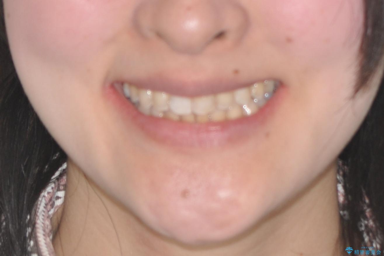 前歯のガタガタを結婚式前にキレイにしたいの治療後（顔貌）