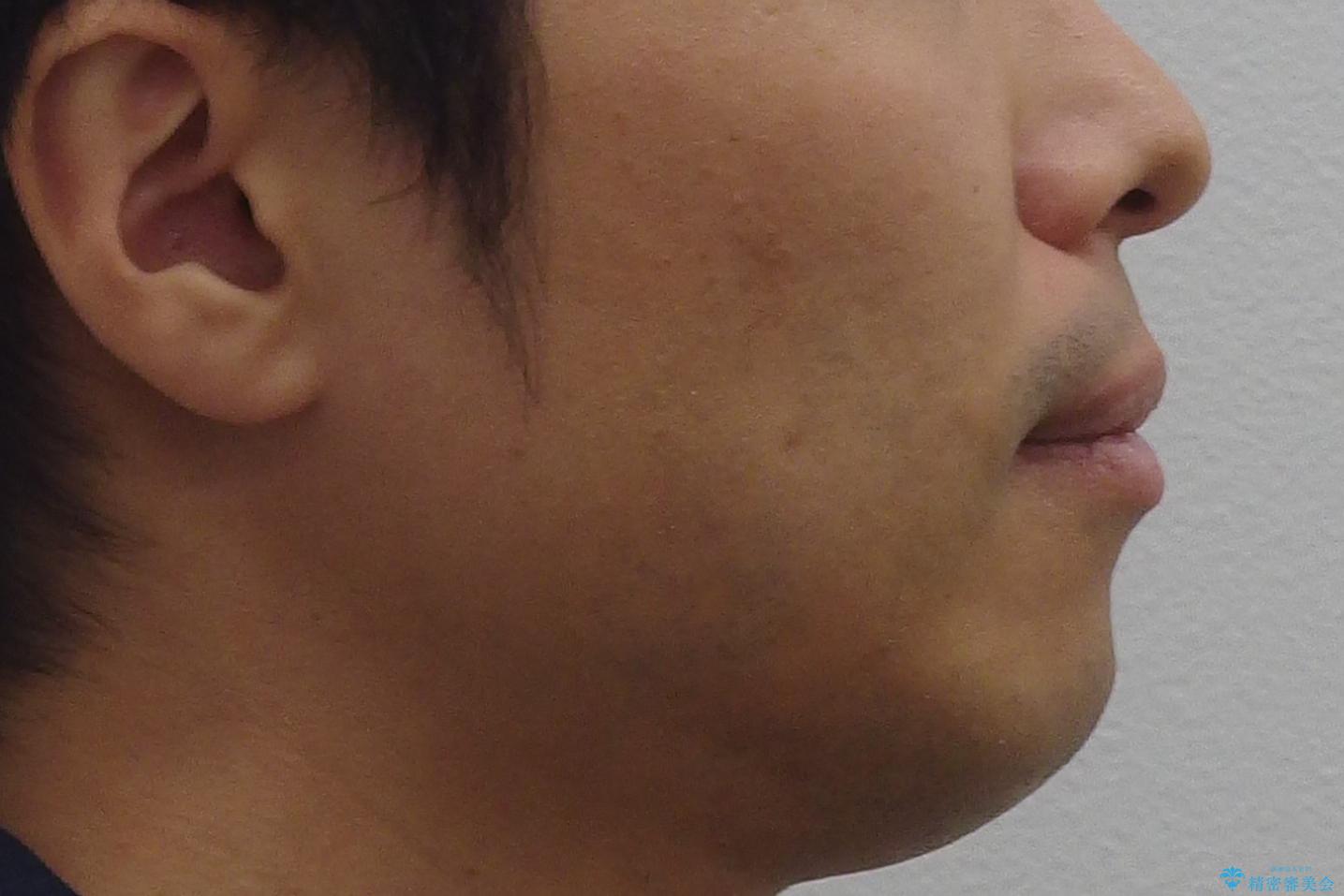 30代男性　歯を抜かないインビザライン　前歯のがたつきの治療の治療前（顔貌）