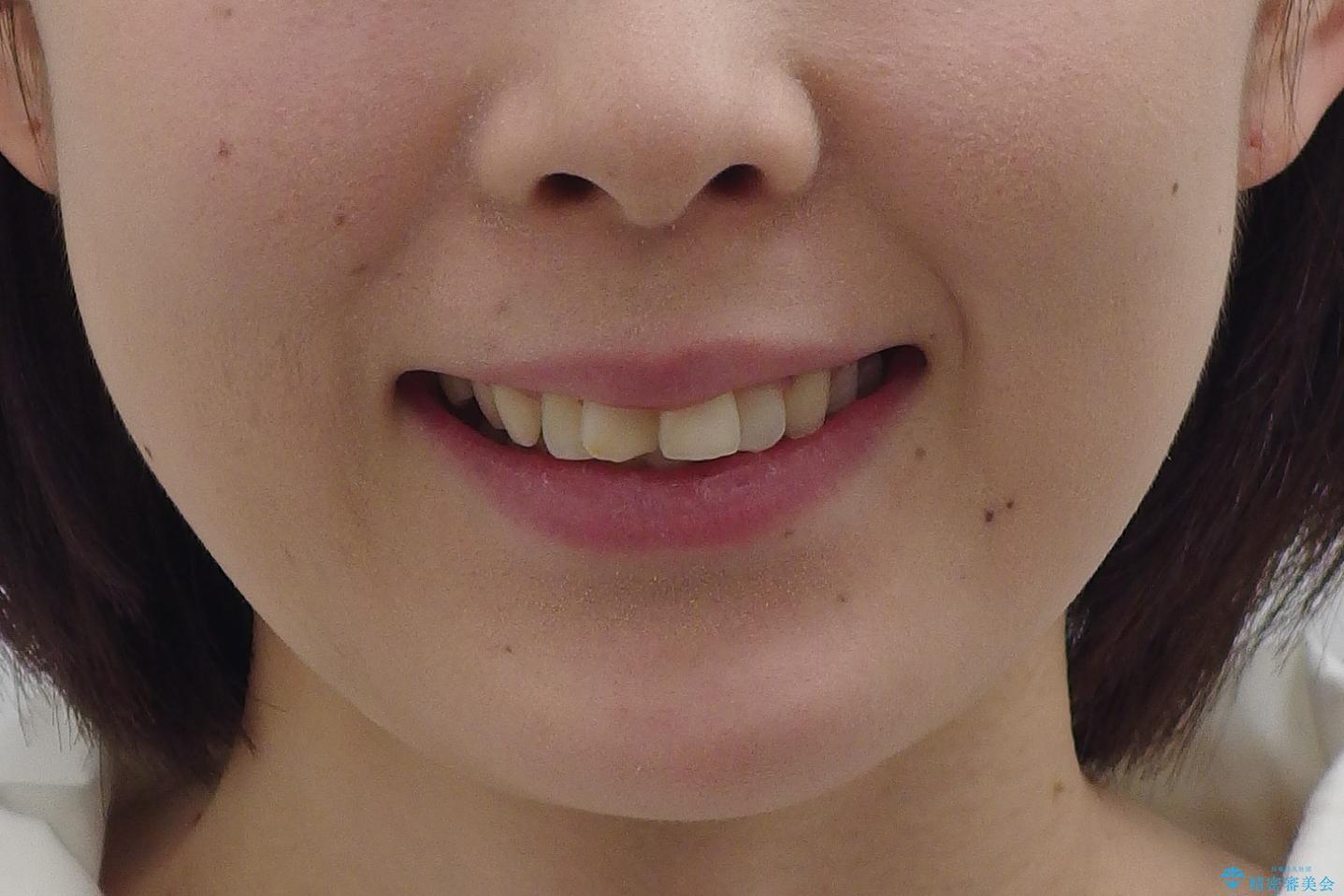 30代女性　抜かない矯正　出っ歯　低位歯を並べましたの治療前（顔貌）