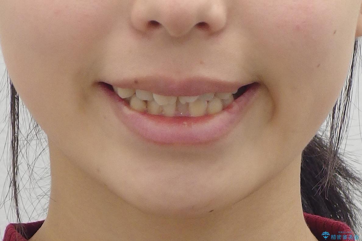 20代女性　前歯のねじれ・出っ歯　インビザラインで奥歯を下げて抜かずに治療の治療前（顔貌）