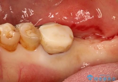 下の奥歯のインプラントと根管治療での咬合回復の治療中