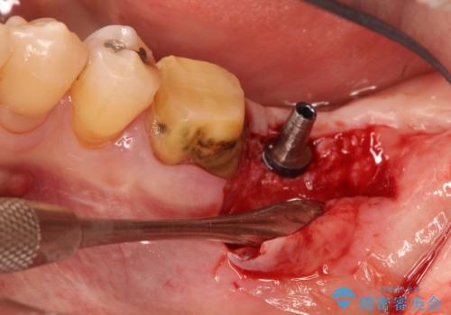 インプラント周囲の歯肉移植～最終的なセラミックを入れるまでの治療中