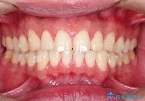 上の前歯に隙間ある　インビザラインによる目立たない矯正の治療中