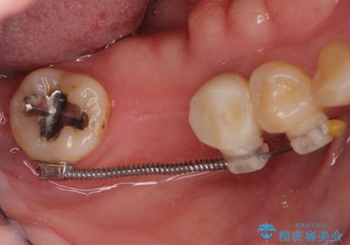 抜けたまま放置した奥歯　部分矯正やインプラントを用いた咬合回復の治療中