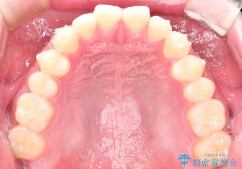 上の前歯に隙間ある　インビザラインによる目立たない矯正の治療中