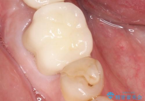 下の奥歯のインプラントと根管治療での咬合回復の治療後