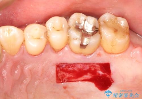 インプラント周囲の歯肉移植～最終的なセラミックを入れるまでの治療中