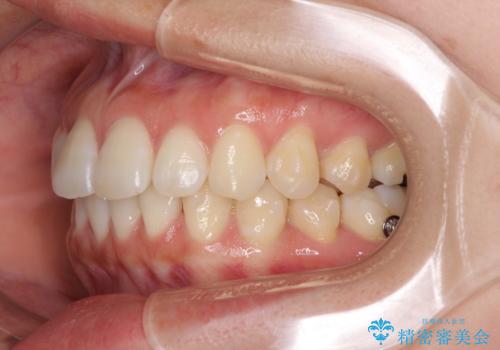 前歯のデコボコと出っ歯を治したい　インビザラインによる非抜歯矯正治療の治療中
