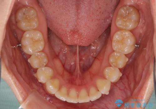 前歯のデコボコと出っ歯を治したい　インビザラインによる非抜歯矯正治療の治療中
