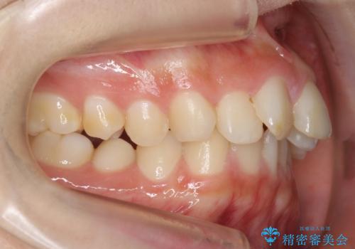 30代女性　抜かない矯正　出っ歯　低位歯を並べましたの治療前