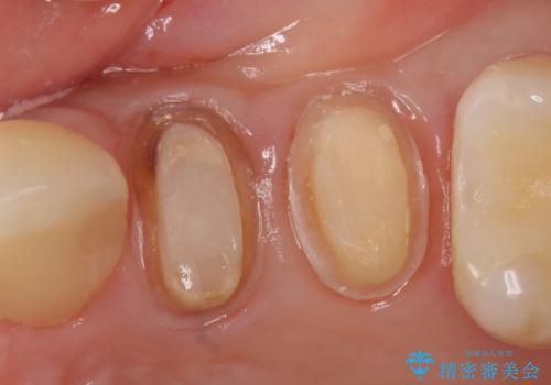 左上4番目の歯で咬むと痛むと来院された方のオールセラミッククラウンの治療中