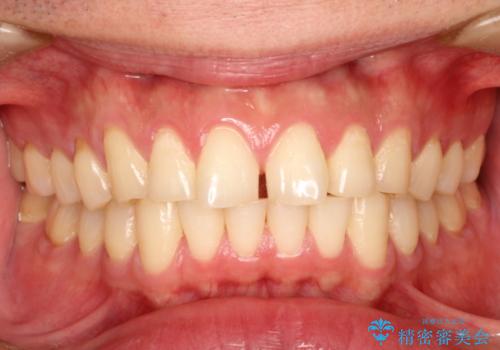 上の前歯に隙間ある　インビザラインによる目立たない矯正の治療前