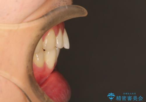 上の前歯に隙間ある　インビザラインによる目立たない矯正の治療前