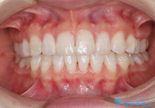 インビザライン・ライトによる前歯部叢生の改善の治療中