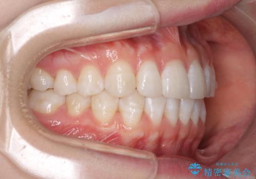 インビザライン・ライトによる前歯部叢生の改善の治療中