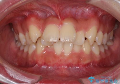 前歯の出っ歯とでこぼこ　目立たないワイヤーで抜歯矯正の治療前