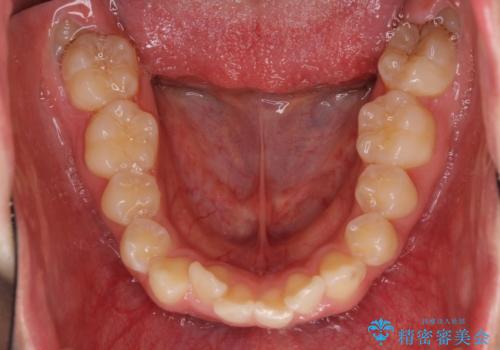 前歯の出っ歯とでこぼこ　目立たないワイヤーで抜歯矯正の治療前