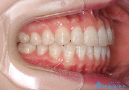 インビザライン・ライトによる前歯部叢生の改善の治療前