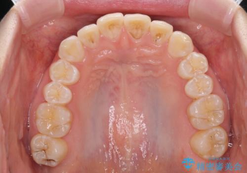インビザライン・ライトによる前歯部叢生の改善の治療前