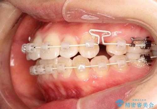 王道・従来のワイヤー矯正　表の装置で手早くきれいな歯並びをの治療中