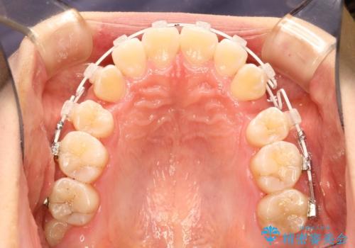 王道・従来のワイヤー矯正　表の装置で手早くきれいな歯並びをの治療中