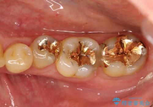 ゴールドインレーにも2次虫歯　再びゴールドインレーにてやり直しの治療前