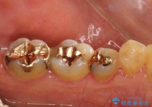 ゴールドインレーにも2次虫歯　再びゴールドインレーにてやり直しの治療前