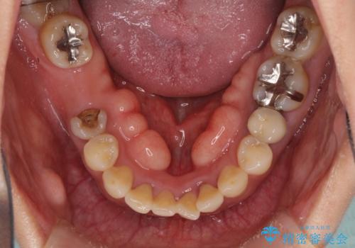 抜けたまま放置した奥歯　部分矯正やインプラントを用いた咬合回復の治療前